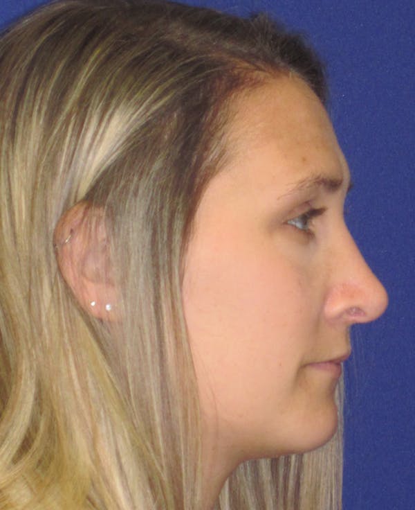 Rhinoplasty Before & After Gallery - Patient 4891145 - Image 4