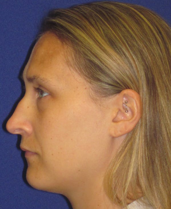 Rhinoplasty Before & After Gallery - Patient 4891145 - Image 5