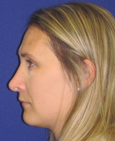 Rhinoplasty Before & After Gallery - Patient 4891145 - Image 6