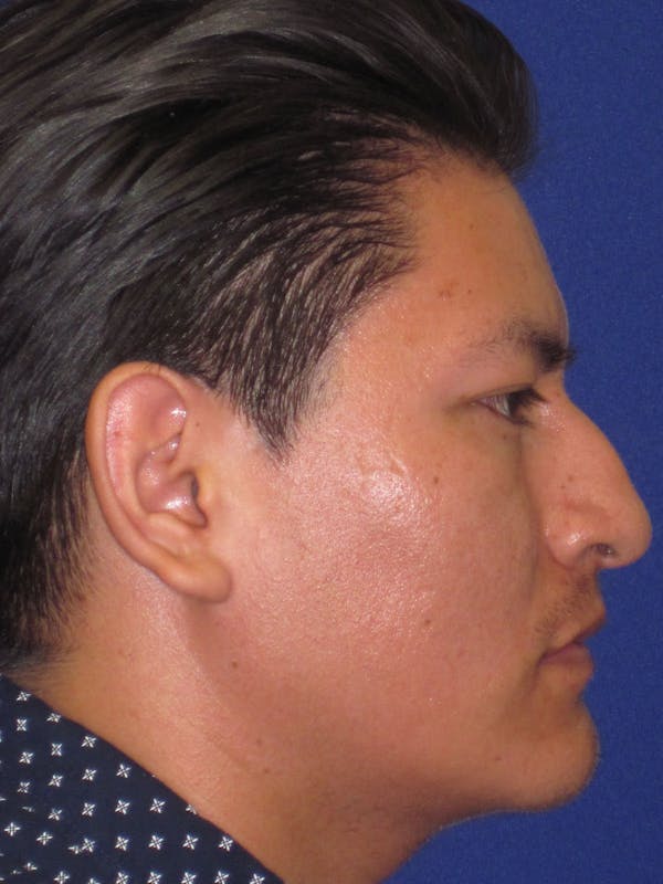 Rhinoplasty Before & After Gallery - Patient 4891195 - Image 1