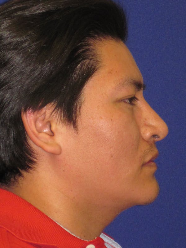 Rhinoplasty Before & After Gallery - Patient 4891195 - Image 2
