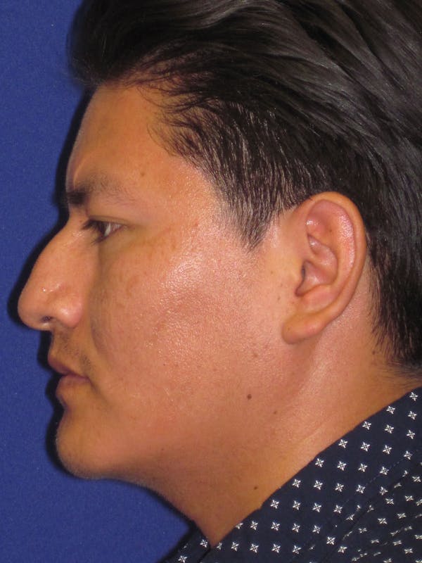 Rhinoplasty Before & After Gallery - Patient 4891195 - Image 5