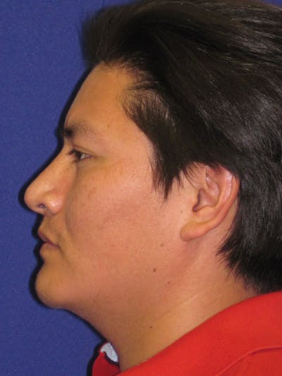 Rhinoplasty Before & After Gallery - Patient 4891195 - Image 6