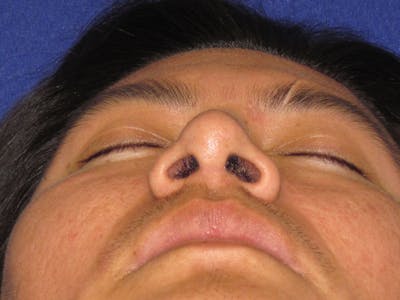 Rhinoplasty Before & After Gallery - Patient 4891195 - Image 10