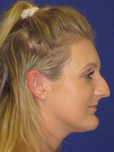 Rhinoplasty Before & After Gallery - Patient 4891196 - Image 1
