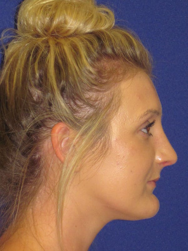 Rhinoplasty Before & After Gallery - Patient 4891196 - Image 2