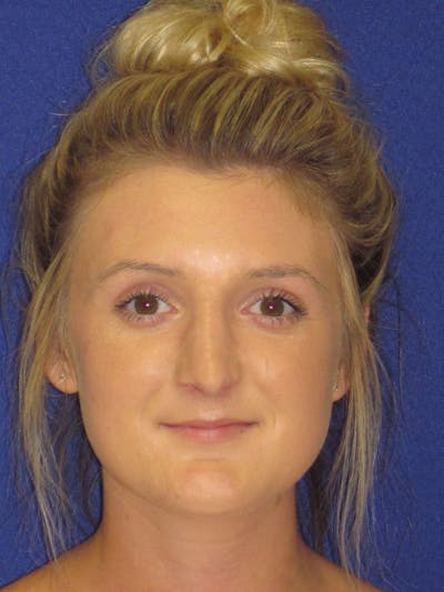 Rhinoplasty Before & After Gallery - Patient 4891196 - Image 4