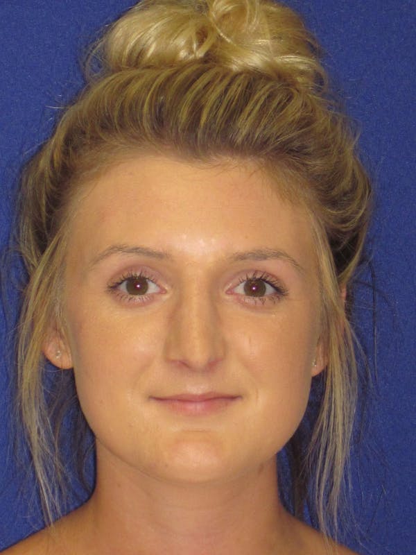 Rhinoplasty Before & After Gallery - Patient 4891196 - Image 4