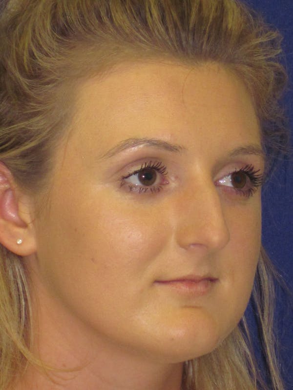 Rhinoplasty Before & After Gallery - Patient 4891196 - Image 5