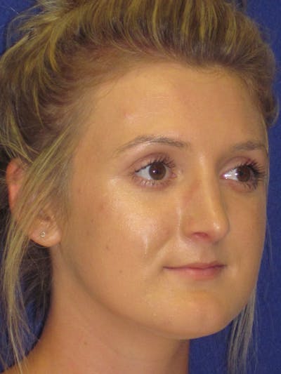 Rhinoplasty Before & After Gallery - Patient 4891196 - Image 6