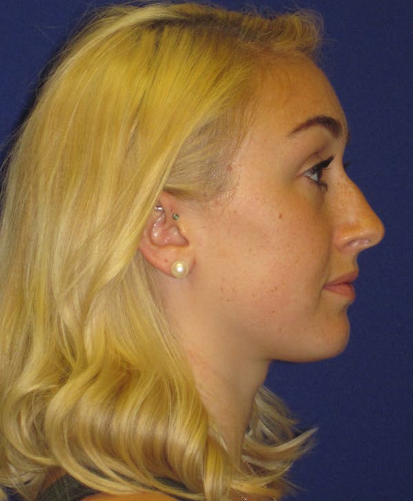 Rhinoplasty Before & After Gallery - Patient 4891200 - Image 3