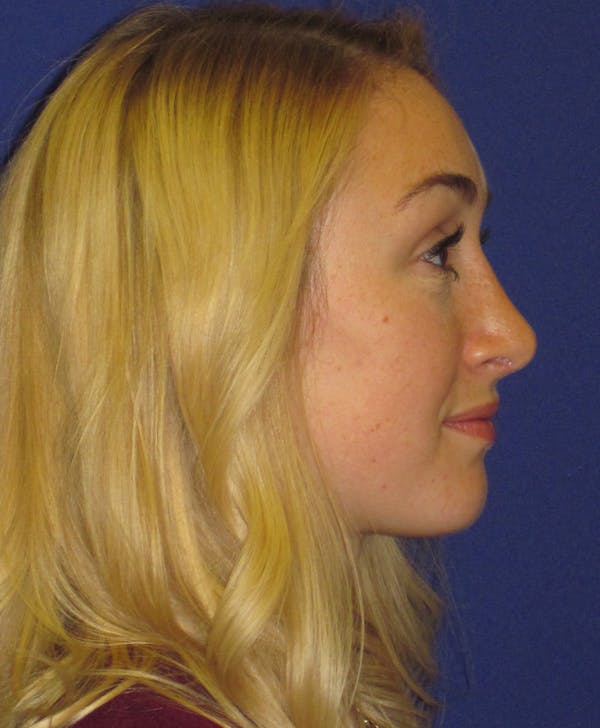 Rhinoplasty Before & After Gallery - Patient 4891200 - Image 4