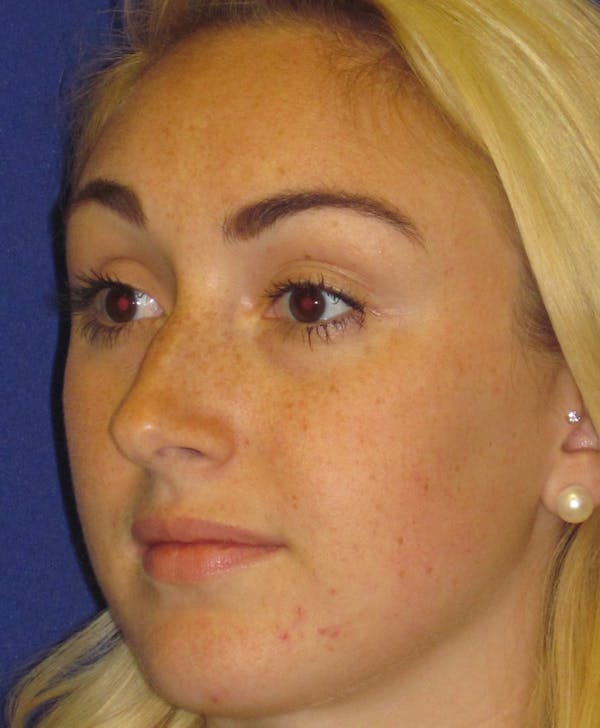 Rhinoplasty Before & After Gallery - Patient 4891200 - Image 5