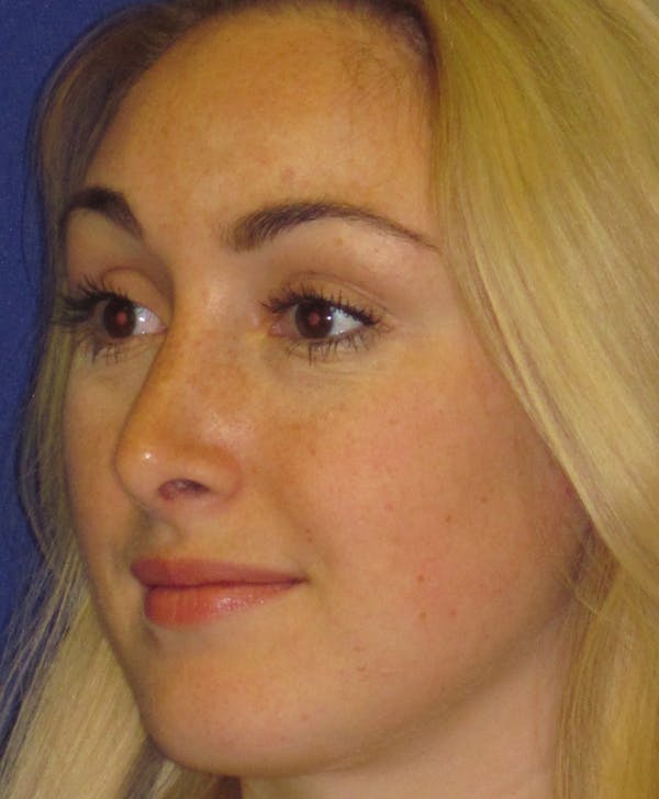 Rhinoplasty Before & After Gallery - Patient 4891200 - Image 6