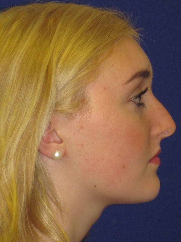 Rhinoplasty Before & After Gallery - Patient 4891201 - Image 3