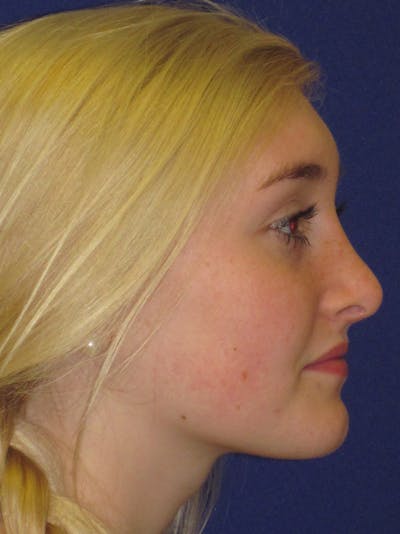 Rhinoplasty Before & After Gallery - Patient 4891201 - Image 4