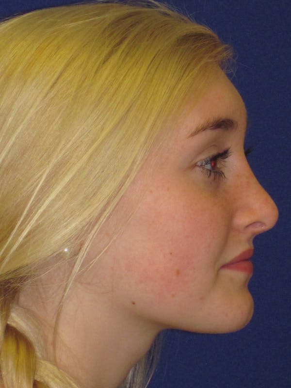 Rhinoplasty Before & After Gallery - Patient 4891201 - Image 4