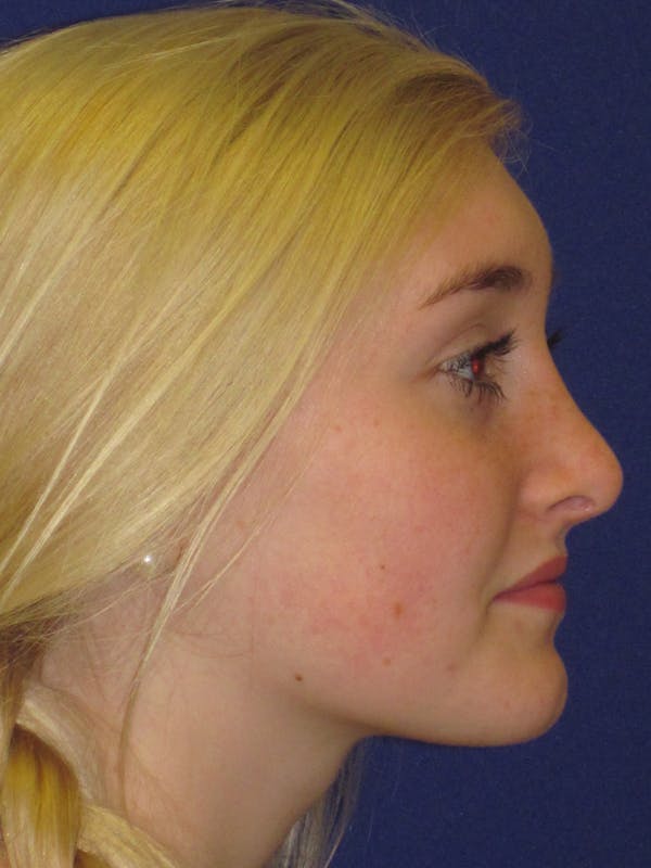 Rhinoplasty Gallery - Patient 4891201 - Image 4