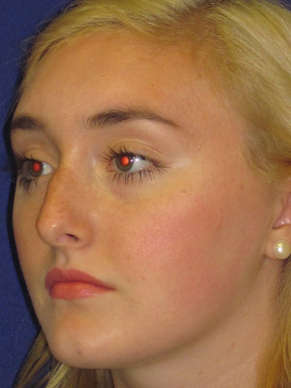 Rhinoplasty Before & After Gallery - Patient 4891201 - Image 5