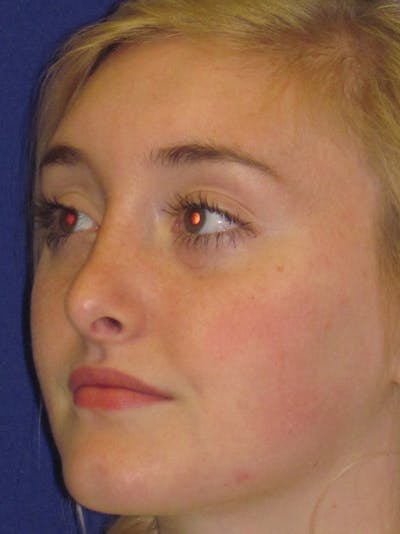 Rhinoplasty Before & After Gallery - Patient 4891201 - Image 6