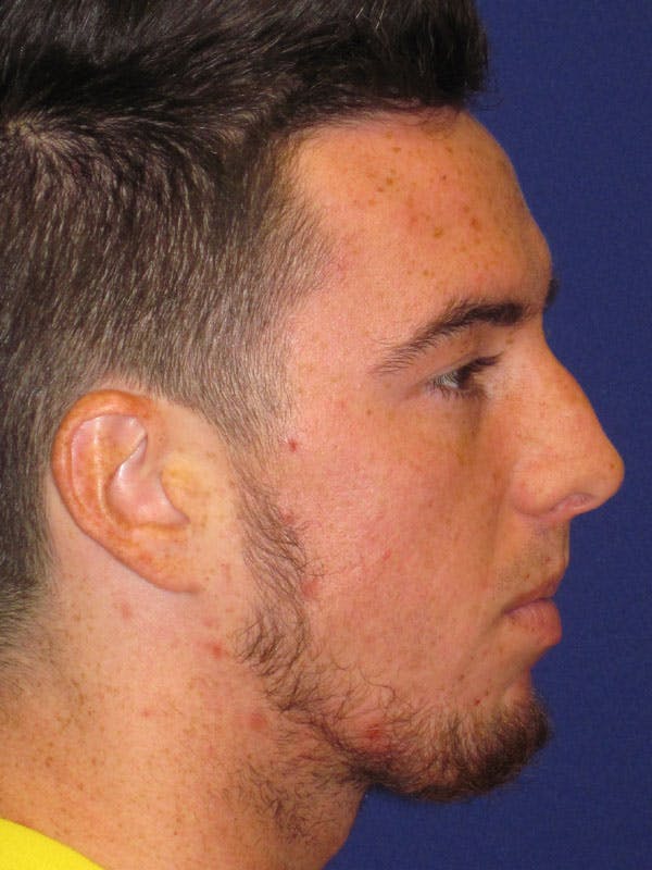 Rhinoplasty Before & After Gallery - Patient 4891203 - Image 5