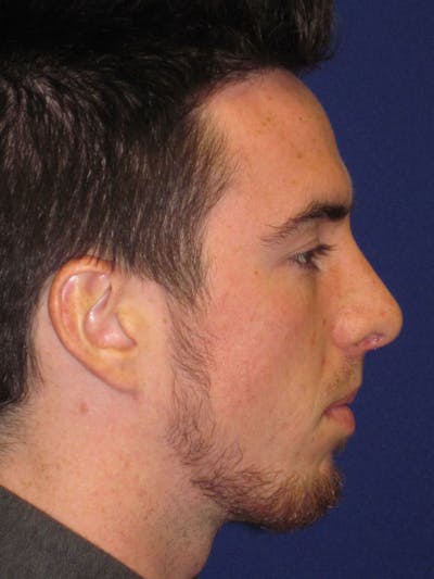 Rhinoplasty Before & After Gallery - Patient 4891203 - Image 6