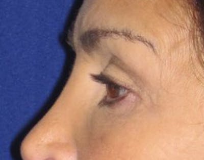 Blepharoplasty Before & After Gallery - Patient 4891204 - Image 1