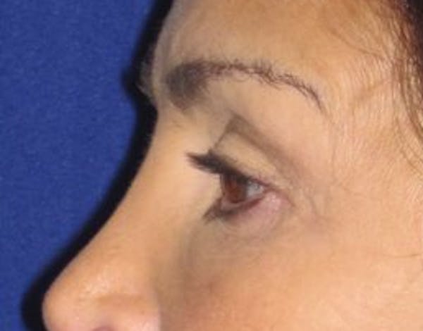 Blepharoplasty Before & After Gallery - Patient 4891204 - Image 1