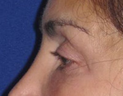 Blepharoplasty Before & After Gallery - Patient 4891204 - Image 2