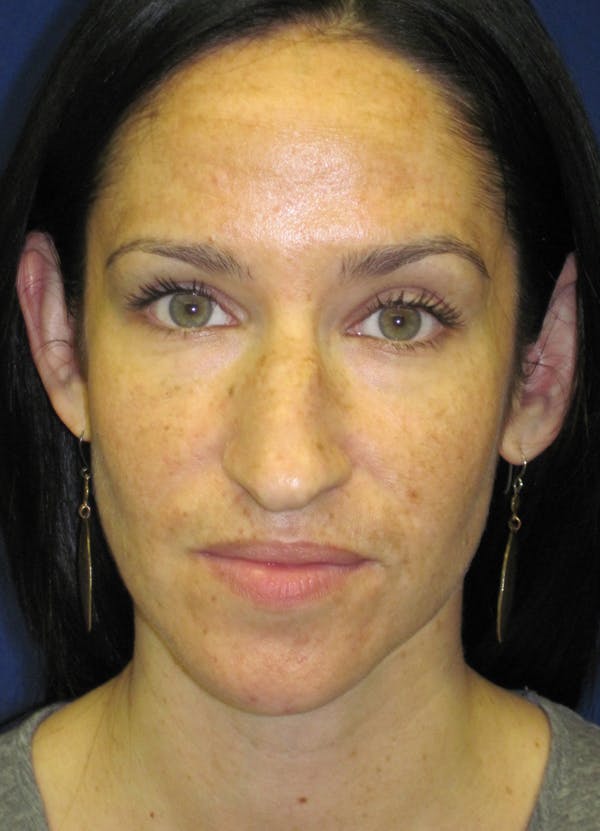 Rhinoplasty Before & After Gallery - Patient 4891207 - Image 3