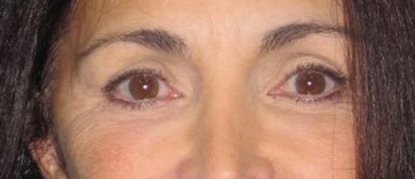 Blepharoplasty Before & After Gallery - Patient 4891204 - Image 3
