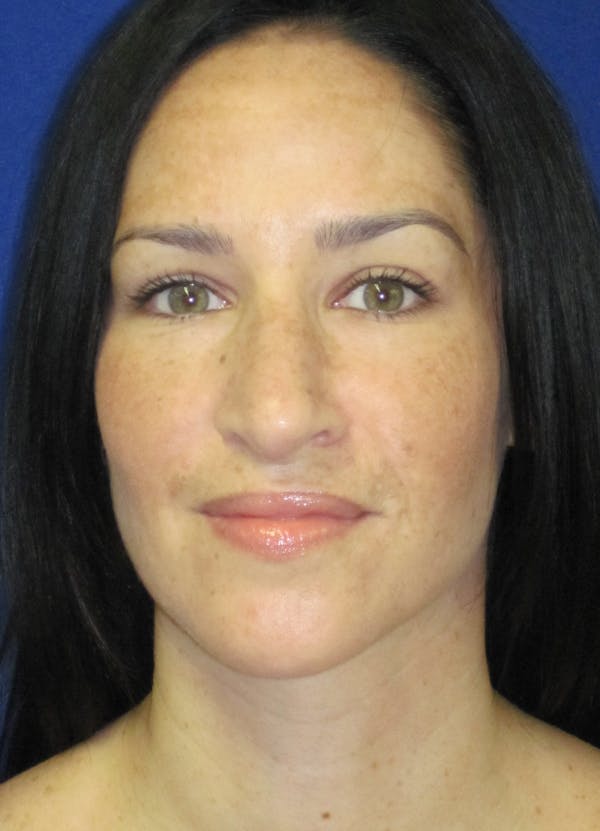 Rhinoplasty Before & After Gallery - Patient 4891207 - Image 4