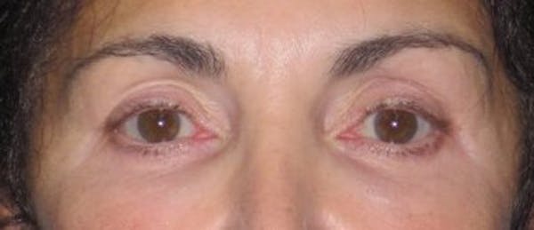 Blepharoplasty Before & After Gallery - Patient 4891204 - Image 4