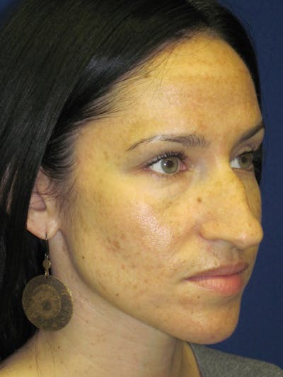 Rhinoplasty Before & After Gallery - Patient 4891207 - Image 1