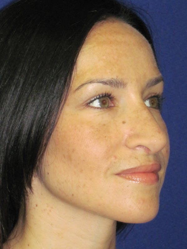 Rhinoplasty Before & After Gallery - Patient 4891207 - Image 2