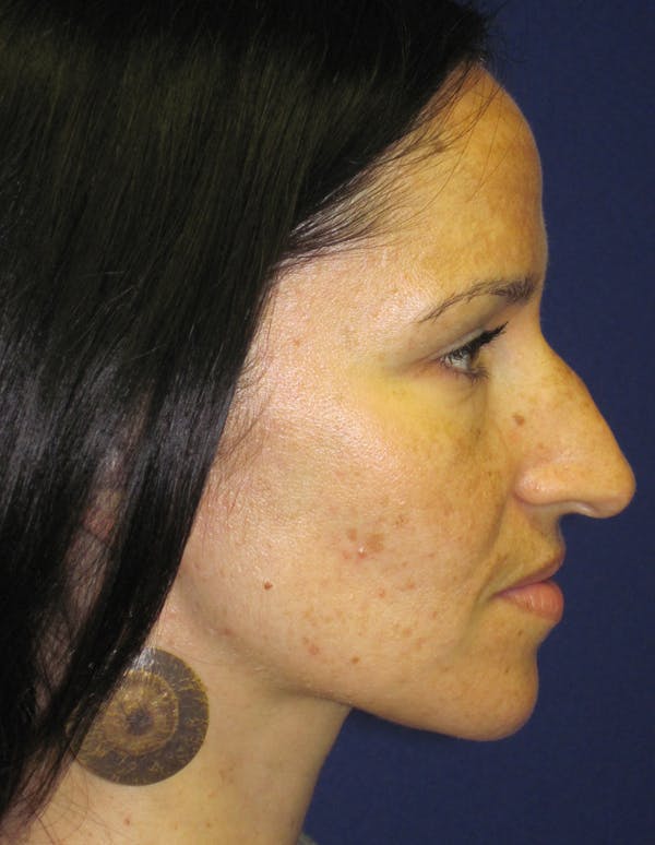 Rhinoplasty Before & After Gallery - Patient 4891207 - Image 5