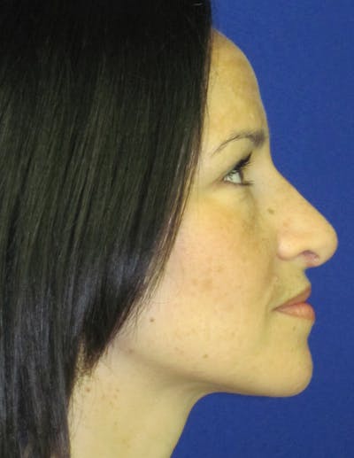 Rhinoplasty Before & After Gallery - Patient 4891207 - Image 6