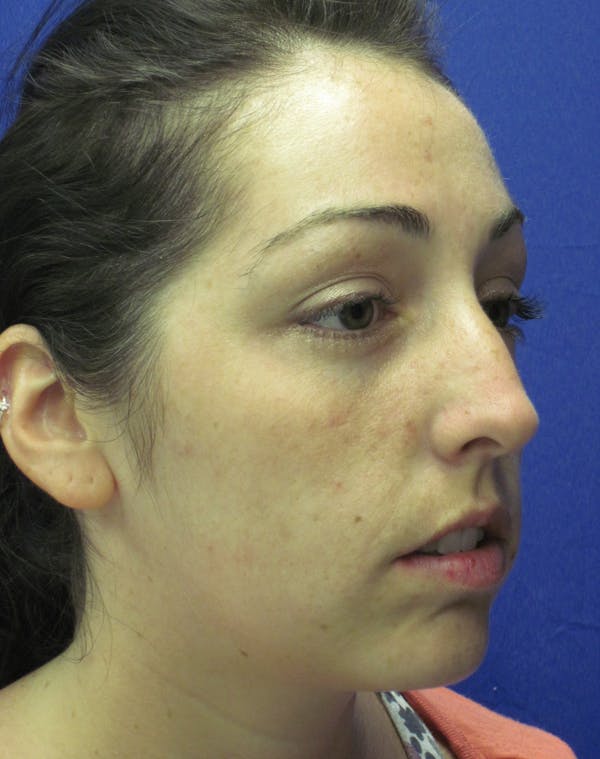 Rhinoplasty Before & After Gallery - Patient 4891283 - Image 5