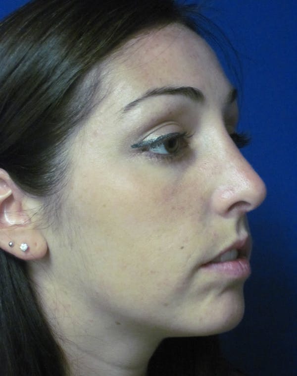Rhinoplasty Before & After Gallery - Patient 4891283 - Image 6
