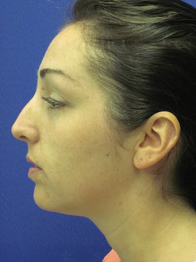 Rhinoplasty Before & After Gallery - Patient 4891283 - Image 1
