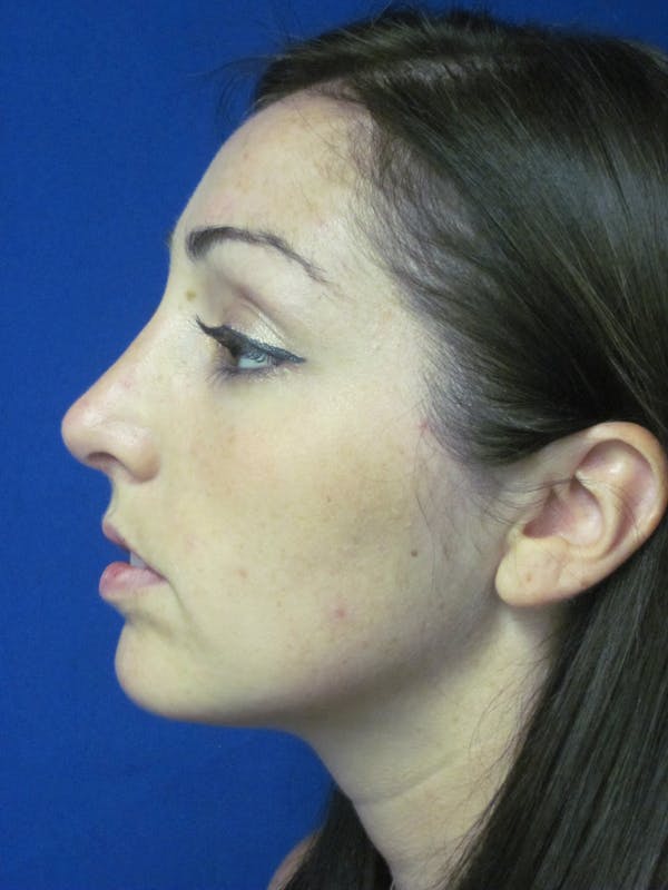 Rhinoplasty Before & After Gallery - Patient 4891283 - Image 2