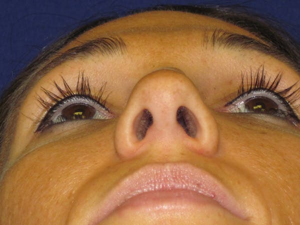 Rhinoplasty Before & After Gallery - Patient 4891305 - Image 1