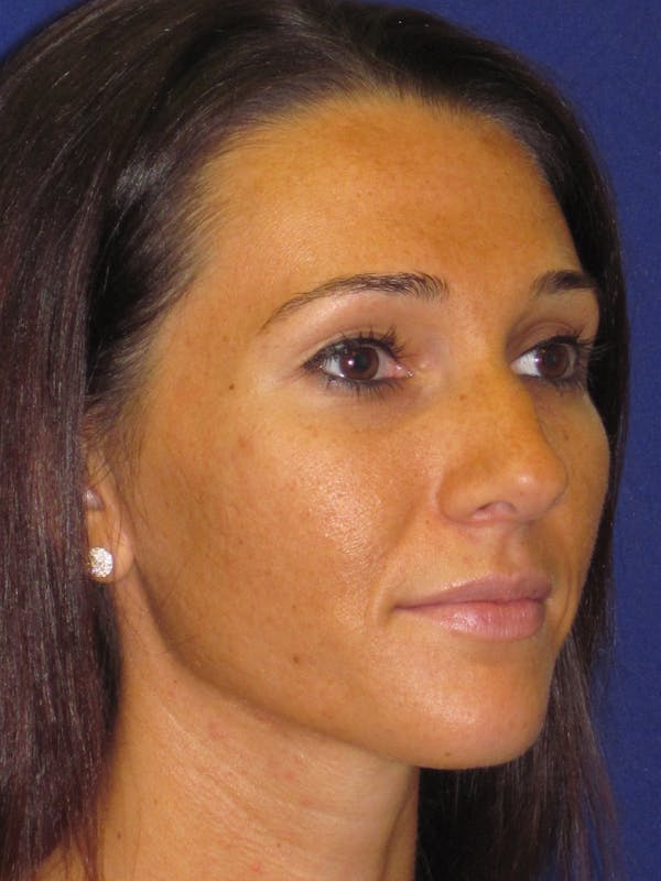 Rhinoplasty Before & After Gallery - Patient 4891305 - Image 3