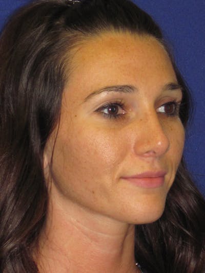 Rhinoplasty Before & After Gallery - Patient 4891305 - Image 4