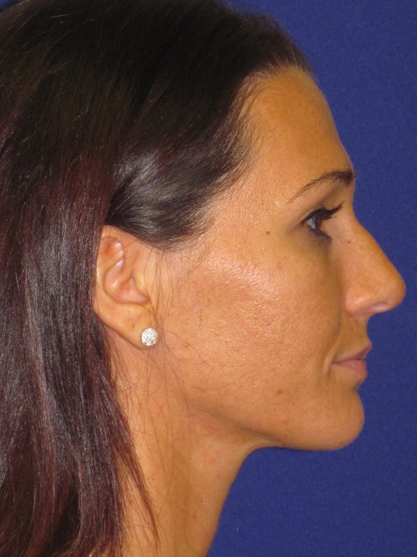 Rhinoplasty Before & After Gallery - Patient 4891305 - Image 5
