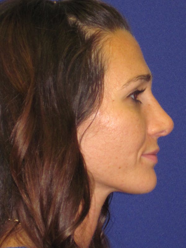 Rhinoplasty Before & After Gallery - Patient 4891305 - Image 6