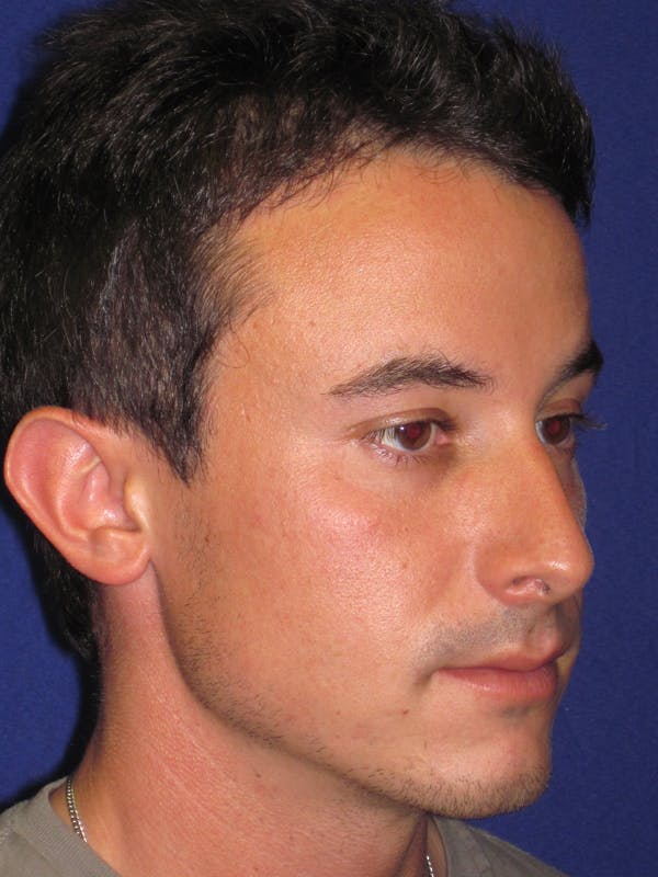 Rhinoplasty Before & After Gallery - Patient 4891308 - Image 3