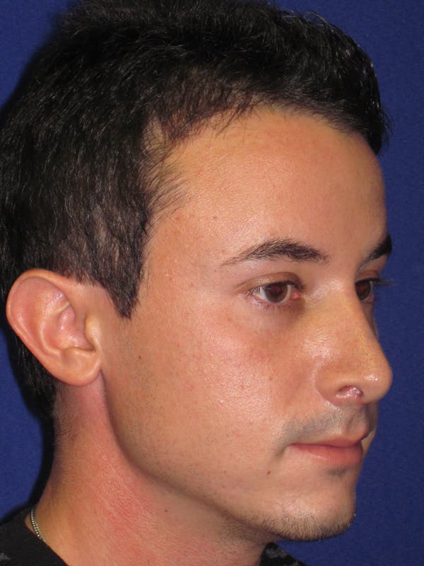 Rhinoplasty Before & After Gallery - Patient 4891308 - Image 4