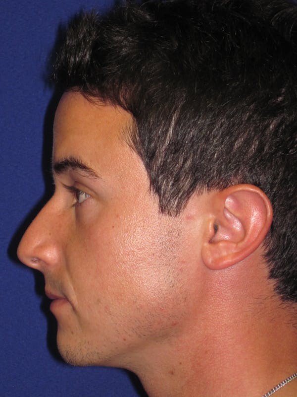 Rhinoplasty Before & After Gallery - Patient 4891308 - Image 5
