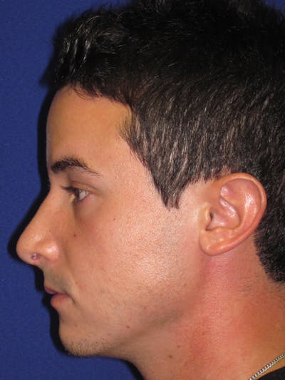 Rhinoplasty Before & After Gallery - Patient 4891308 - Image 6